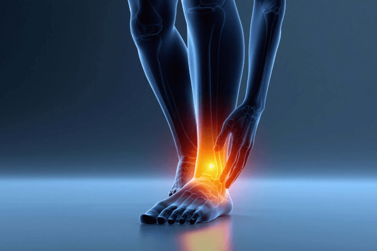 Sinus Tarsi Syndrome