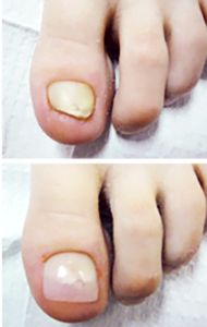keryflex-nail-restoration