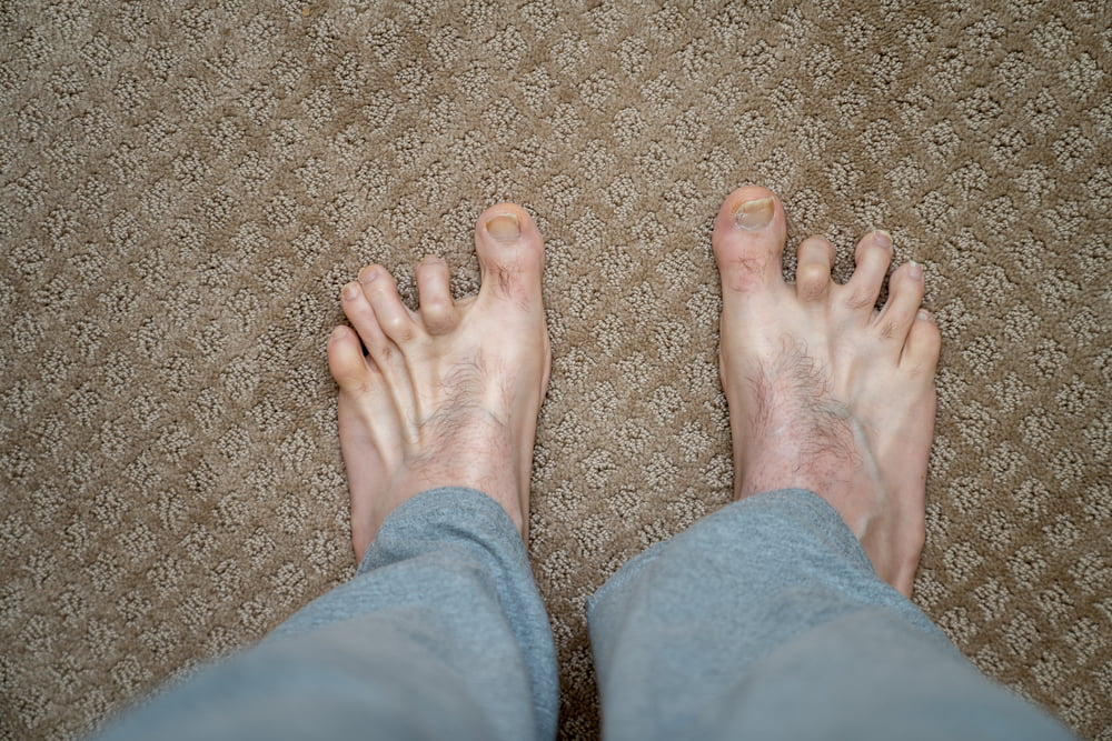 Don't Let Hammertoes Get the Best of You! Here's How to Find the Best Treatment