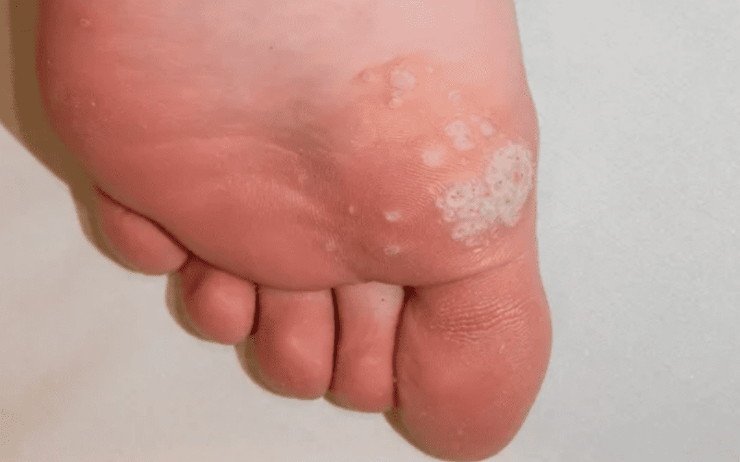 A Comprehensive Guide To Plantar Warts And Their Management